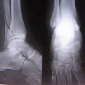 中医正骨治疗腓骨下段骨折典型病案一例 ，附点评
