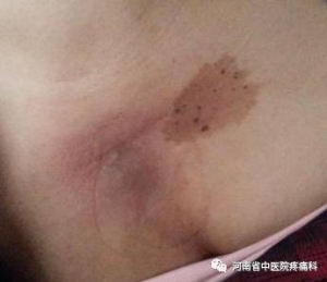 不容小觑，左前臂持续疼痛竟由乳腺肿瘤引起！