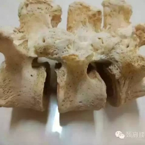 解剖标本：腰3-5脊椎小关节骨化融合 及其临床探讨
