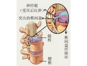 腰椎间盘突症患者需要睡硬板床这是为什么?
