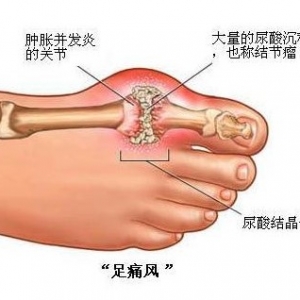 得了痛风还能吃肉吗?
