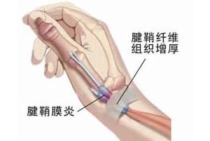 几种动作巧妙预防腱鞘炎