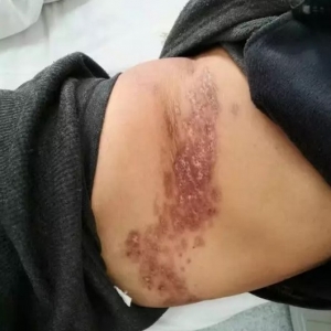 带状疱疹后遗神经痛典型病例分享
