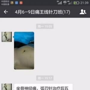 坐骨神经痛，痛王弧刃针治疗后五分钟症状消失