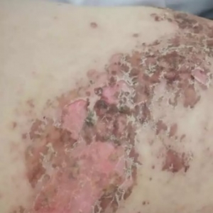 腹部带状疱疹经弧刃针标准疗法治疗的病案分享