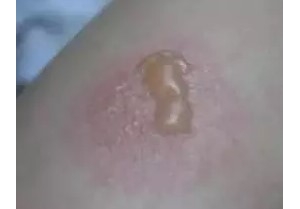 带状疱疹症状表现有哪些?