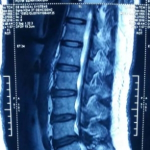 腰椎间盘突出和腰椎间盘突出症是两个不同的概念