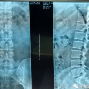 典型病例—腰痛别老找椎间盘的事儿