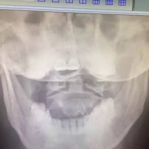 颈项部酸痛伴有发作性头晕呕吐症状的弧刃针标准疗法治疗