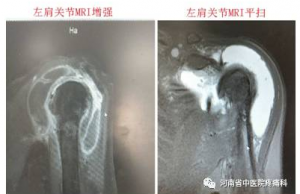 一例左肩部巨大包块典型病例分享