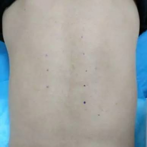 一例脊柱侧弯背部疼痛典型病例分享