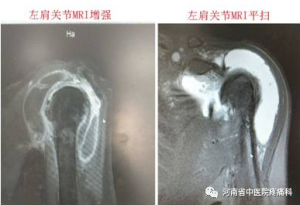 一例左肩部巨大包块典型病例分享