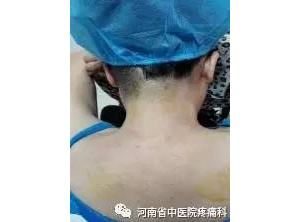 一例颈椎病引起顽固性头痛典型病例分享