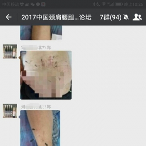 痛王弧刃针被赞：真神！无激素无麻药，5分钟搞定