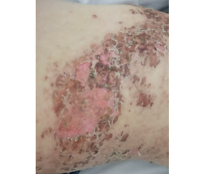 肺心病患者带状疱疹怎么治疗风险最低？