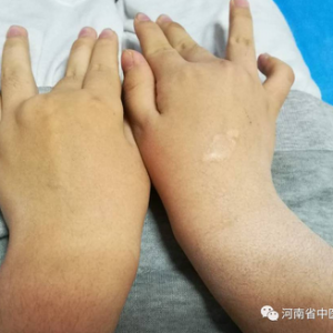 一例弧刃针标准疗法治疗关节强直典型病例分享