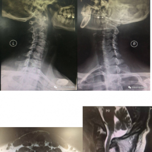神经根型颈椎病一例典型病例分享