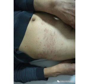 带状疱疹后遗神经痛一例典型病例分享