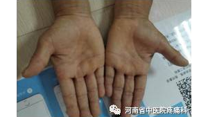 您还在为“扳机指”烦恼吗？一例典型病例分享