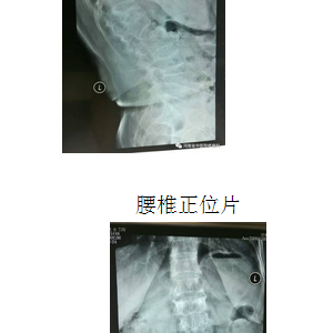 一例弧刃针治疗腰椎压缩性骨折疼痛典型病例分享