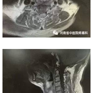 一例神经根型颈椎病典型病例分享