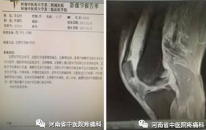 一例膝关节滑膜炎典型病例分享