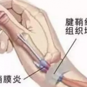 做到四点有效预防腱鞘炎