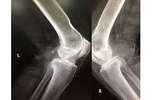 双膝关节疼痛15年，经痛王弧刃针标准疗法治疗显著减轻
