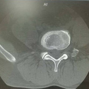 30多岁办公室职员得了腰椎间盘突出症怎么治？