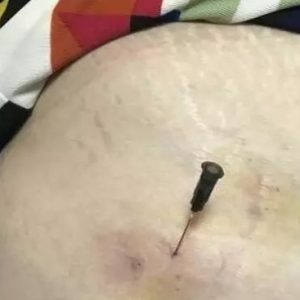 弧刃针治疗股外侧皮神经卡压综合征导致的大腿外侧麻木
