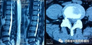 运动员腰痛病弧刃针治好了