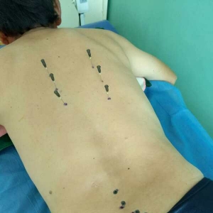 背部疼痛不能平睡左腿麻木，弧刃针治疗后明显好转