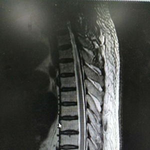 一例胸神经后支卡压综合征典型病例分享