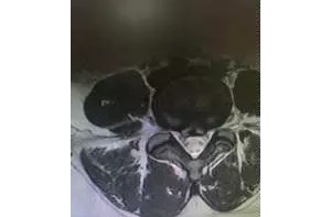 26岁白领腰疼腿麻木腰椎间盘突出症罪魁祸首，弧刃针消痛有妙招 ...
