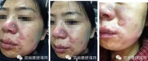 王氏万应药酒之火灸疗法治疗面部带状疱疹一例典型病案 ...
