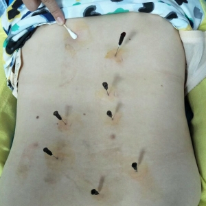 痛王弧刃针标准疗法治疗长期久坐引起腰背部慢性疼痛