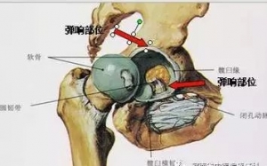 髋关节屈伸运动时出现弹响即弹响髋——骨科、疼痛科常见疾病 ...