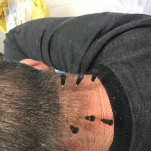 颈部疼痛伴功能活动受限，经痛王弧刃针刀治疗后缓解