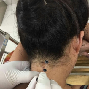 颈椎病伴左侧肩胛区疼痛，弧刃针刀治疗后症状缓解