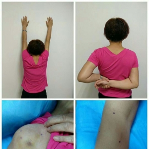 外伤致肩关节疼痛不能正常活动，弧刃针疗法治疗后恢复良好 ...