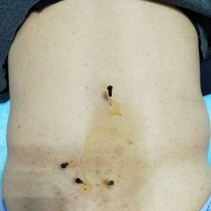 一例76岁老人腰源性腹痛的治疗病例分享