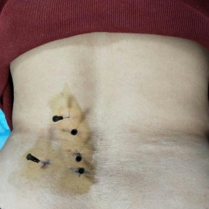 腰部疼痛伴左下肢疼痛，痛王弧刃针治疗两次后症状缓解大半 ...