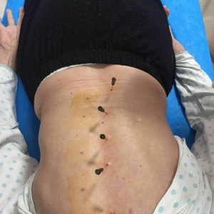 长期胸背部疼痛诊断为胸腰椎小关节错缝的临床治疗方法