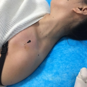 爱美女士的苦恼，我知道！典型病案：胸小肌损伤一例病案