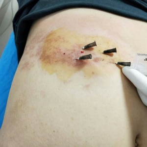 带状疱疹疼痛难忍痛王弧刃针皮下扫散效果好