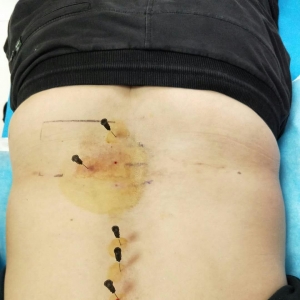 腰椎间盘突出症腰部间断疼痛下肢酸困的弧刃针临床治疗