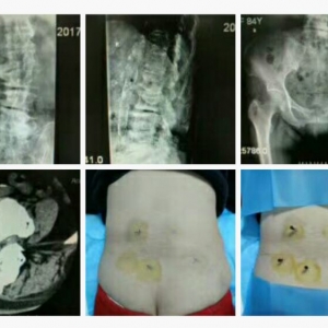腰髋部疼痛患者的弧刃针临床治疗病例