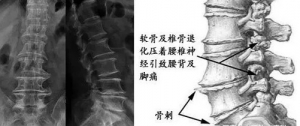颈肩腰腿痛网：什么是骨质增生