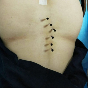 参加弧刃小针刀治疗腰椎间盘突出症培训后的临床病例分享