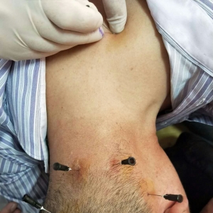 颈性头痛头晕专业培训后，学员弧刃针临床治疗案例分享